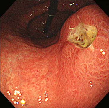 胃潰瘍2