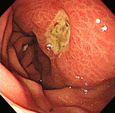 胃潰瘍1