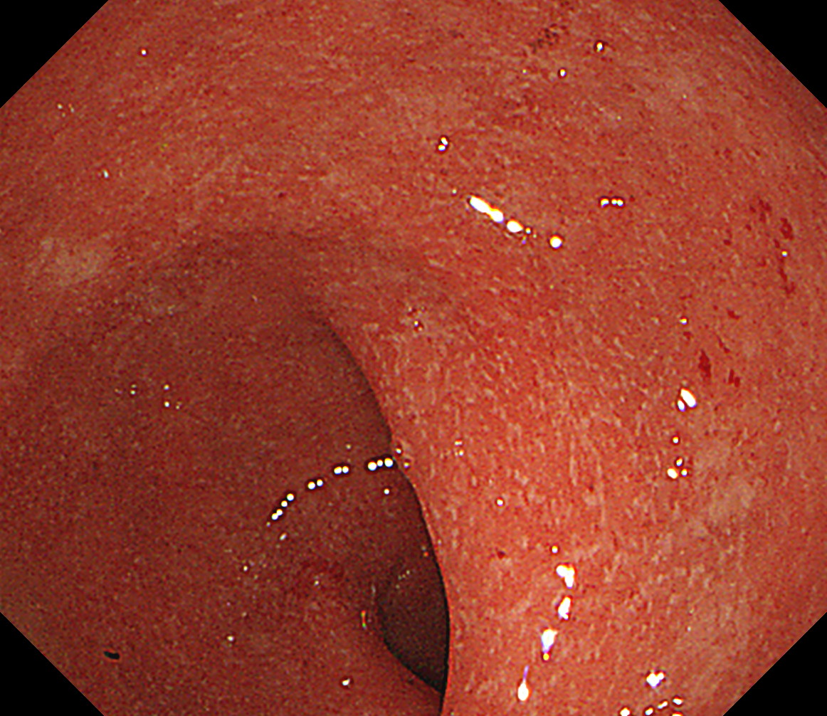 潰瘍性大腸炎2