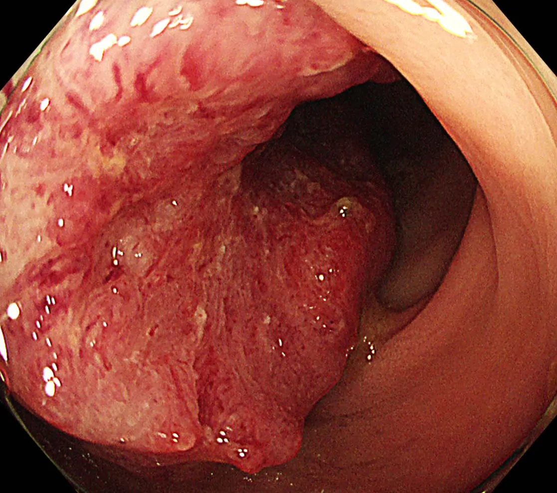 大腸がん2