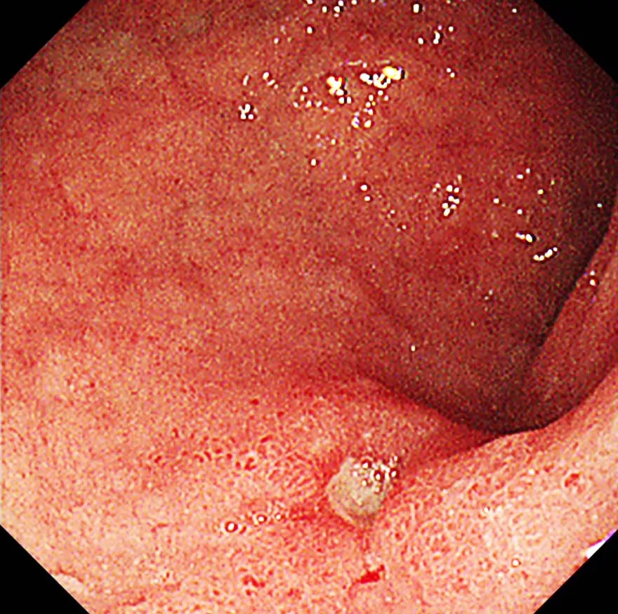 十二指腸潰瘍1