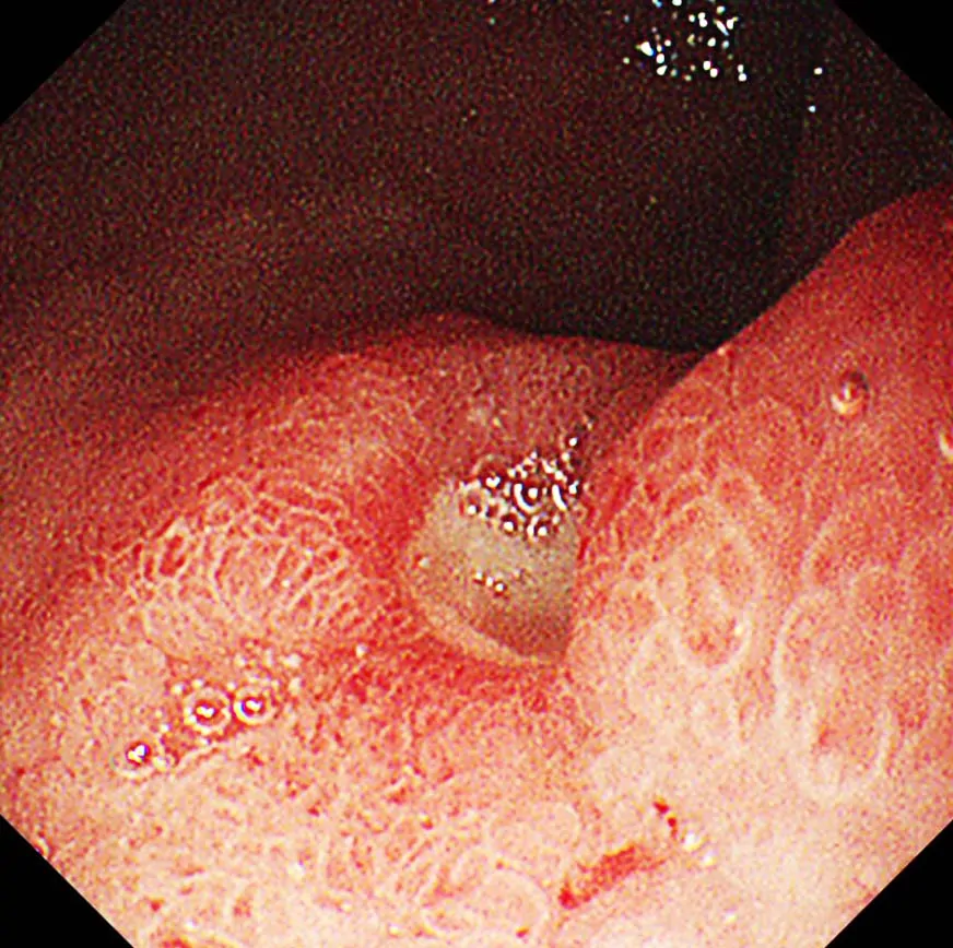 十二指腸潰瘍2